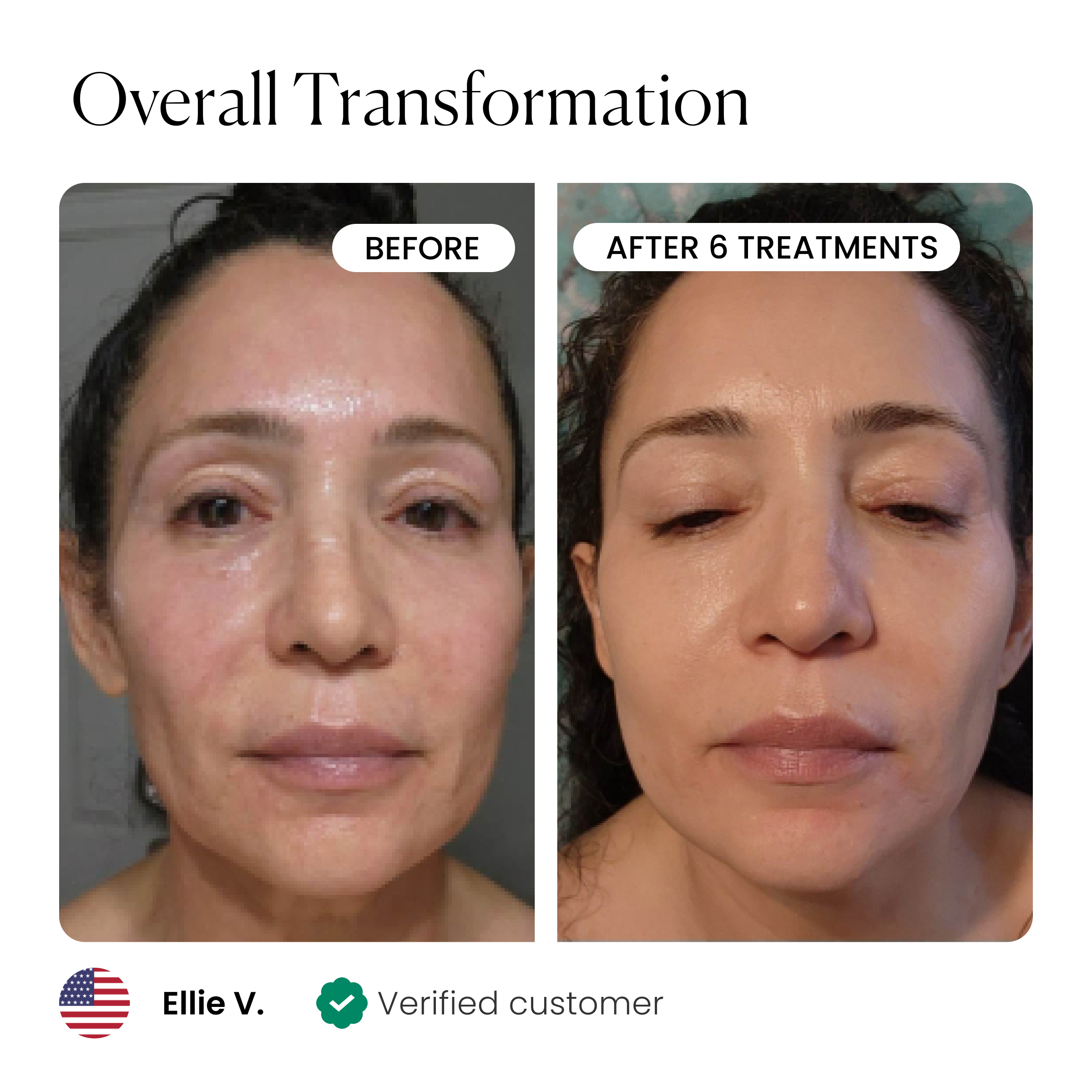 Microneedling Serum | Eliminate Fine Lines & Wrinkles