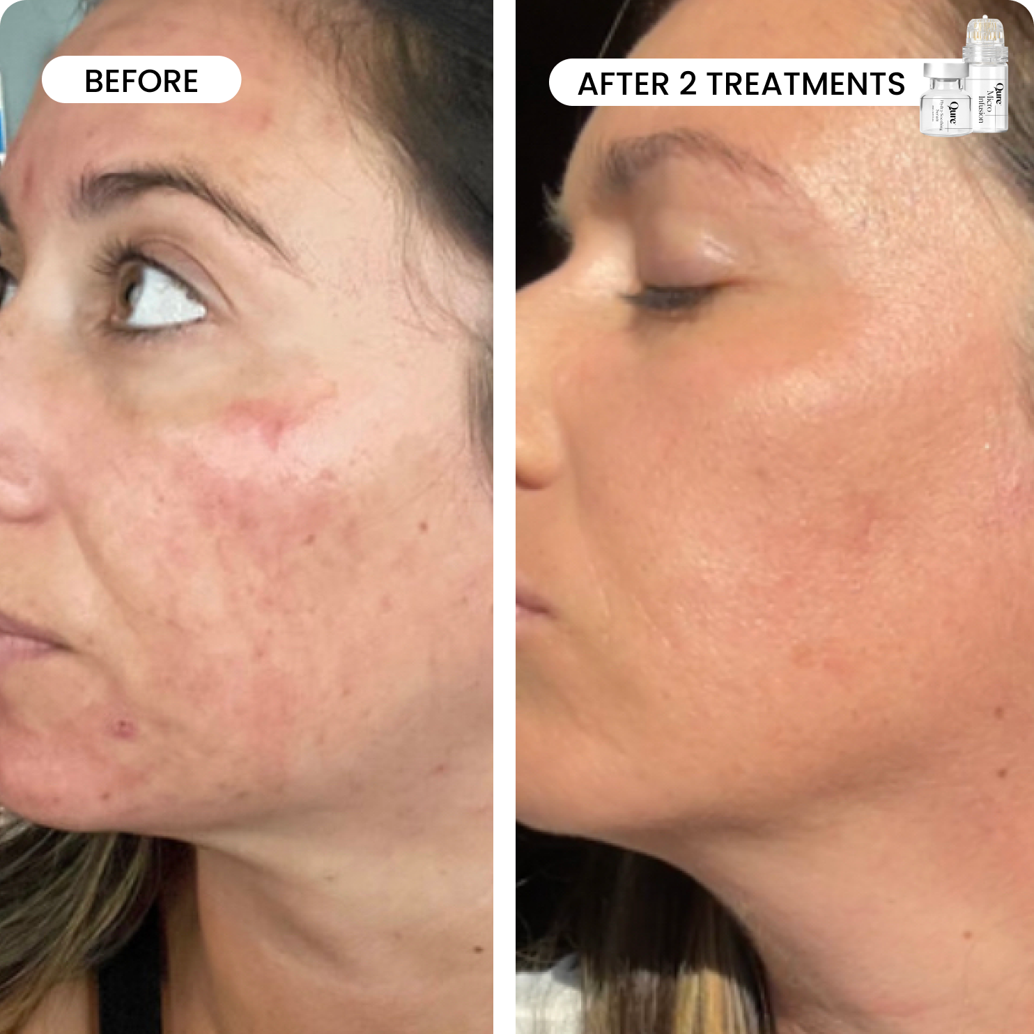 美容液 QURE Micro-Infusion 3 Month Micro-Infusion 3 Month Bundle (For Dark Spots)