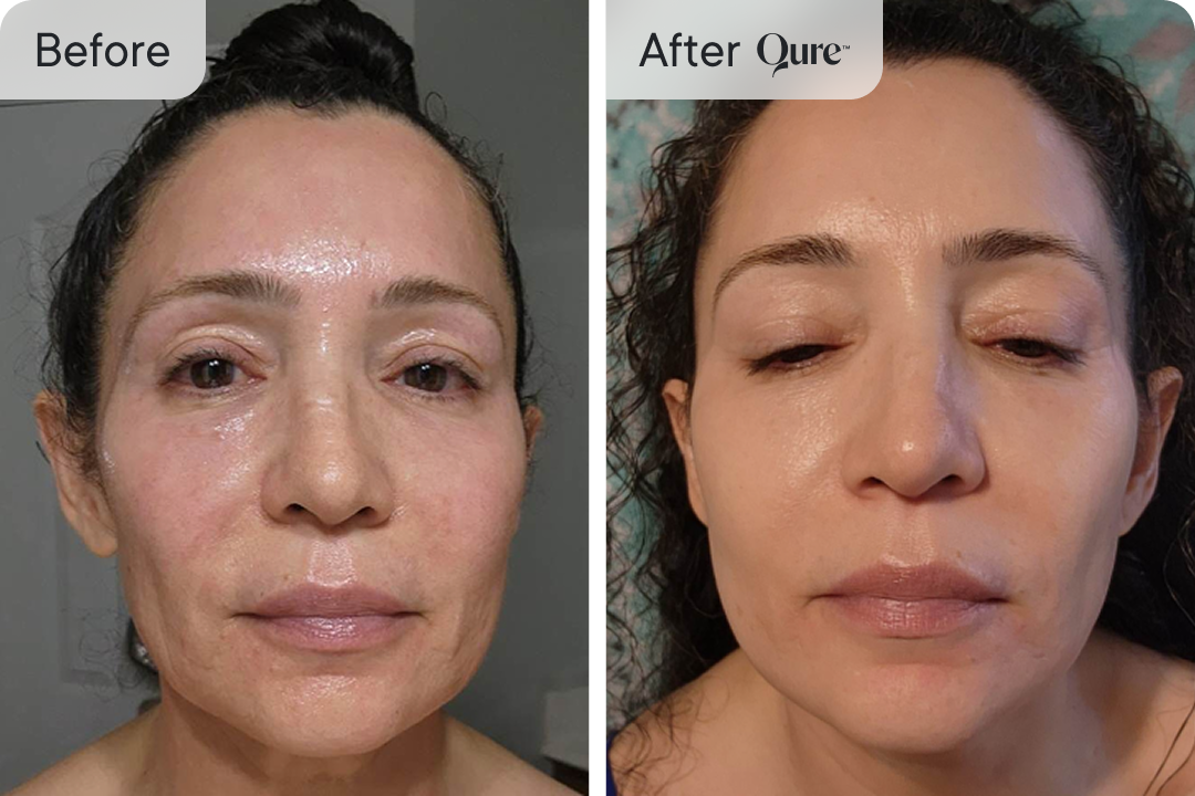 Qure skin treatment before and after results
