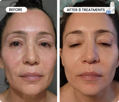 Line Refine Bundle Advanced