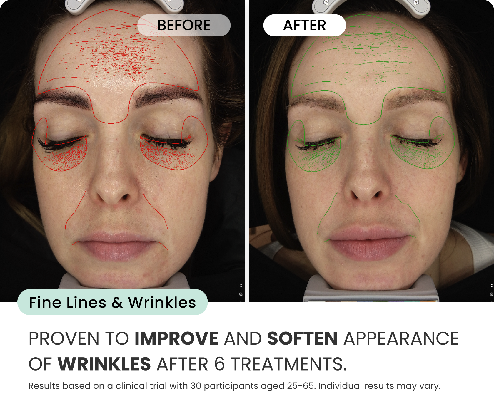 Micro-Infusion 3 Month BOGO (For Wrinkles)