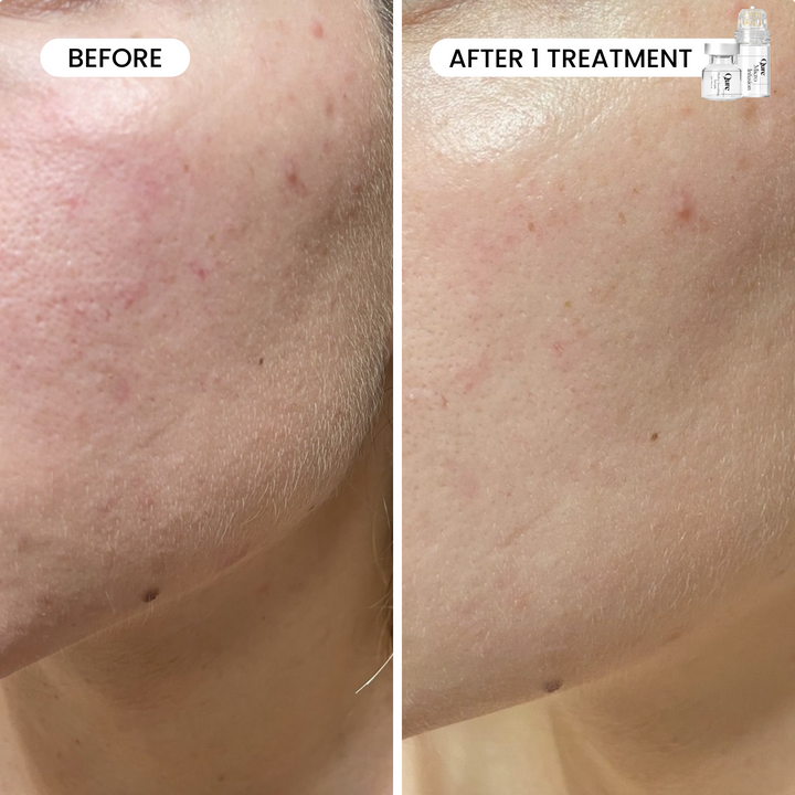 Micro-Infusion 2 Month Bundle (For Dark Spots)