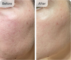 Before & After skin improvement