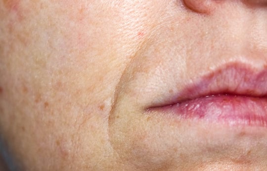 microneedling for smile lines