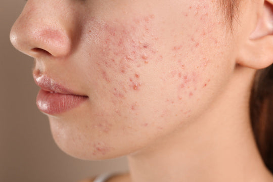 microneedling for PIE