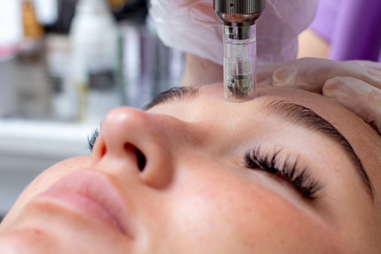 is microneedling safe