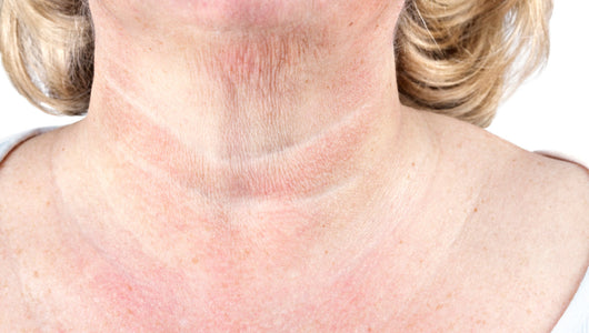 microneedling for crepey skin