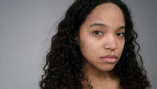 microneedling for acne scars