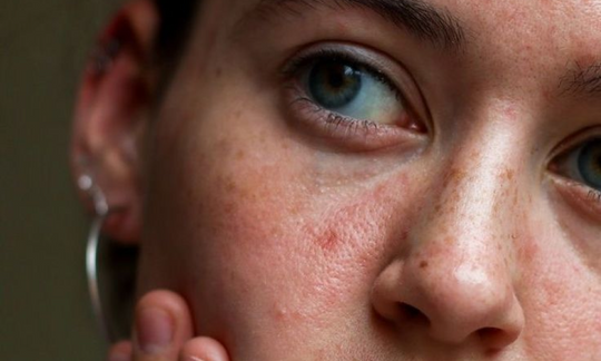 How Cortisol Affects the Skin: The Stress-Skin Connection and What You Can Do