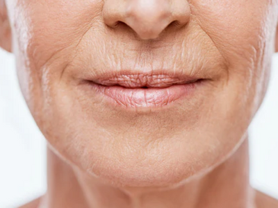 microneedling for wrinkles