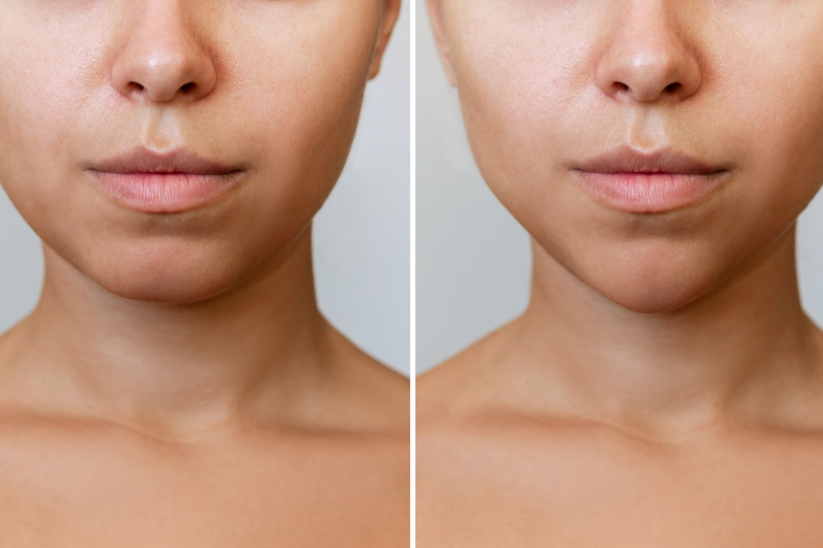 Botox Red Red Light Therapy After Botox: When To Restart Safely