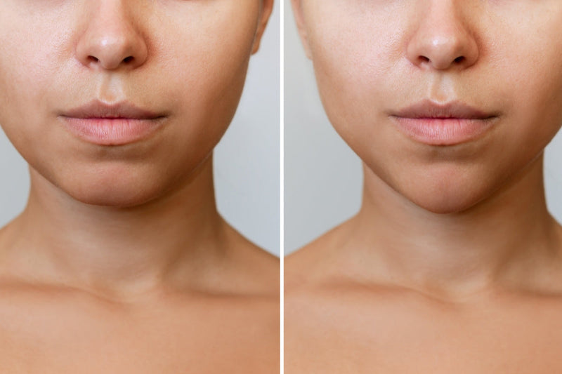 Before and after facial comparison examining does red light therapy cause fat loss in the face concerns.