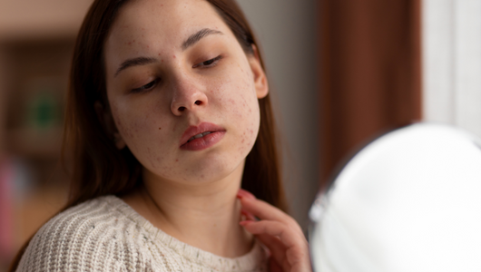 How to Help Your Skin Heal Naturally and Bounce Back from Acne Scars