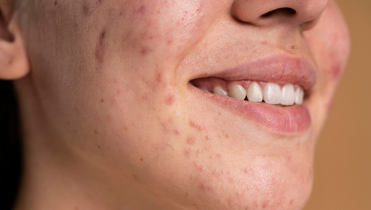 The Dirty Truth: 6 Everyday Habits that Are Causing Breakouts