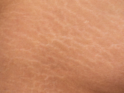 Red Light Therapy Stretch Marks