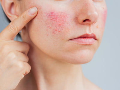 Woman with skin irritation, wondering does red light therapy help heal wounds_jpeg