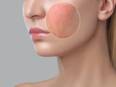 Zoom in on irritated skin that is falsely attributed as red light therapy detox symptoms.