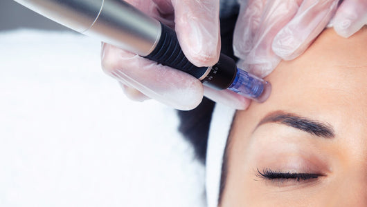 itching after microneedling