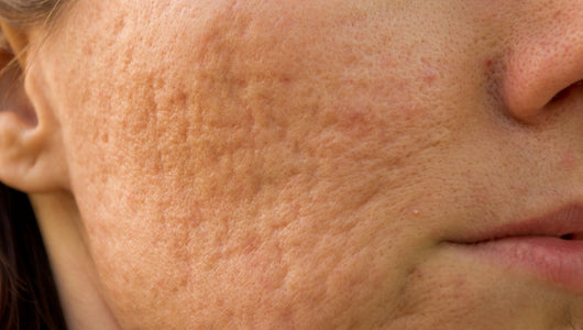 how to get rid of acne scars