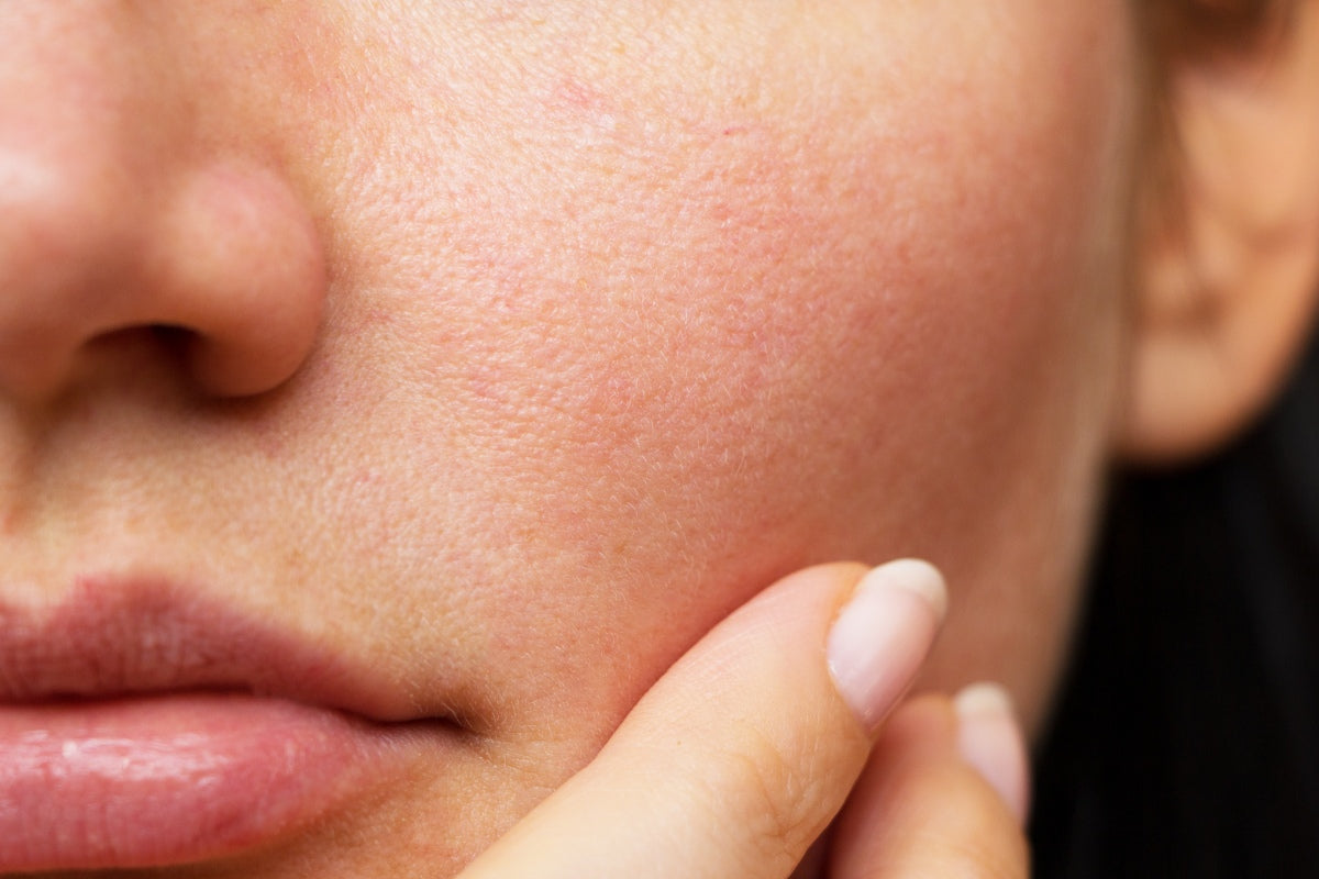 is blue light or red light better for acne