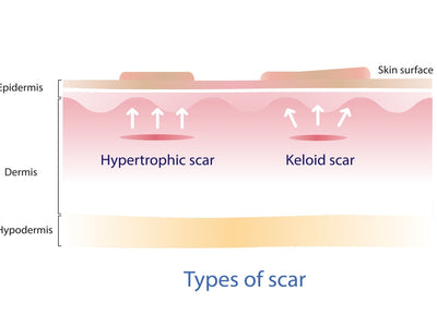 red light therapy keloid scars