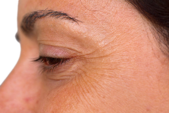 microneedling crows feet