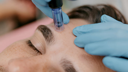 microneedling men