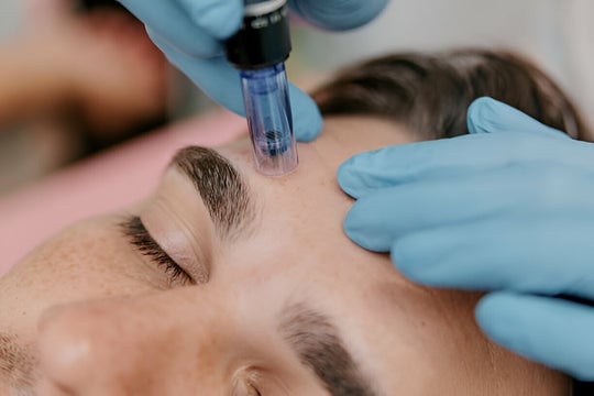 microneedling men