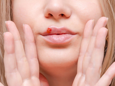 Red Light Therapy for Cold Sores