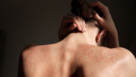 red light therapy for psoriasis