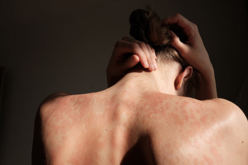 red light therapy for psoriasis