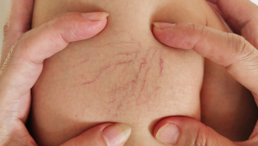 Red Light Therapy for Varicose Veins