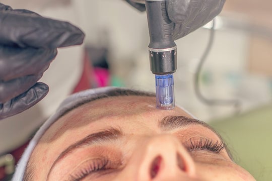 what does microneedling feel like