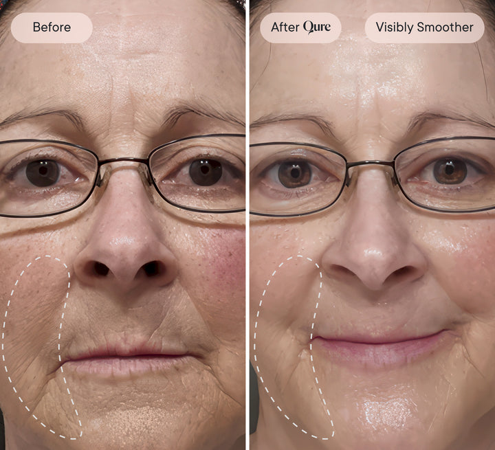 Qure Micro-Infusion System – #1 Derm Rated Original Micro-Infusion