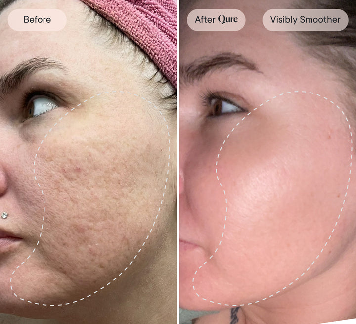 where to inject ghk cu for face reddit Ghk-Cu Experienxe : r/Peptides 54 YEARS OLD, Visible pores.,