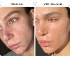 Micro-Infusion For Wrinkles (2 Refill Treatments)