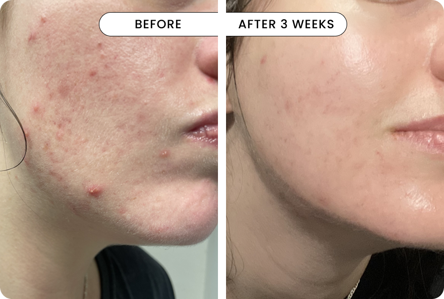 result Q-Rejuvalight Pro Facewear