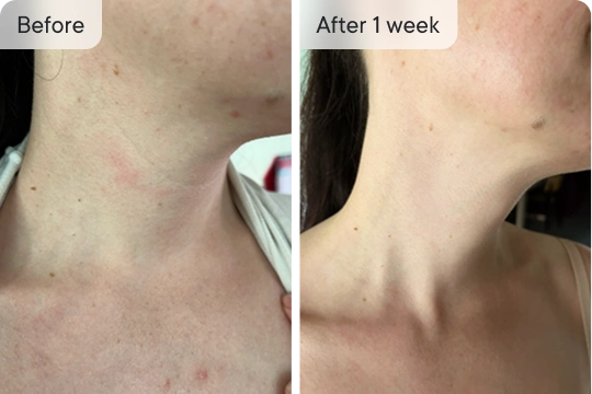 Claudia's neck before & after 1 week