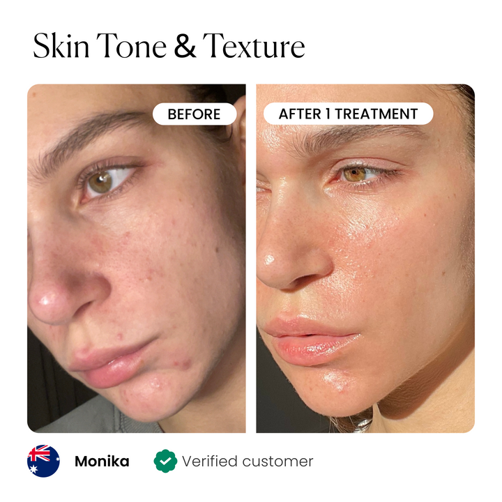 Micro-Infusion 1 Month Bundle (For Wrinkles)