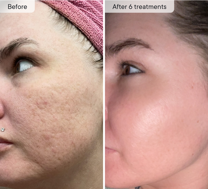 Qure Micro-Infusion System #1 Derm Rated Original Micro-Infusion Qure Micro-Infusion System #1 Derm Rated Original Micro-Infusion