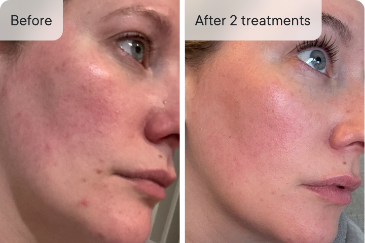 Qureo Inj Qure Micro-Infusion System – #1 Derm Rated Original Micro-Infusion