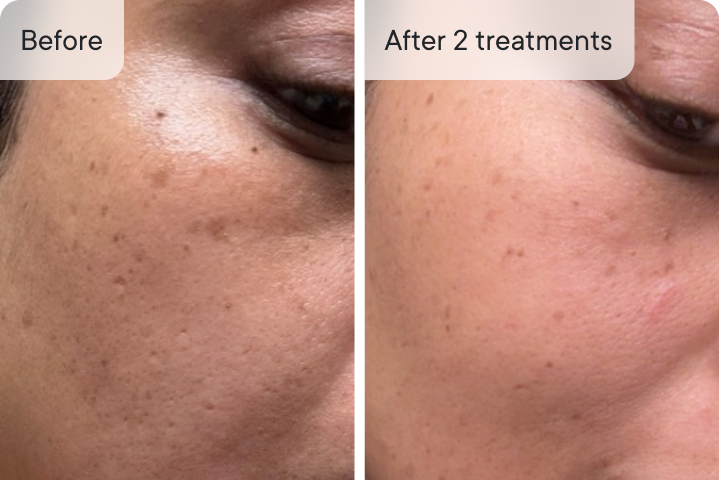 Qureo Inj Qure Micro-Infusion System – #1 Derm Rated Original Micro-Infusion