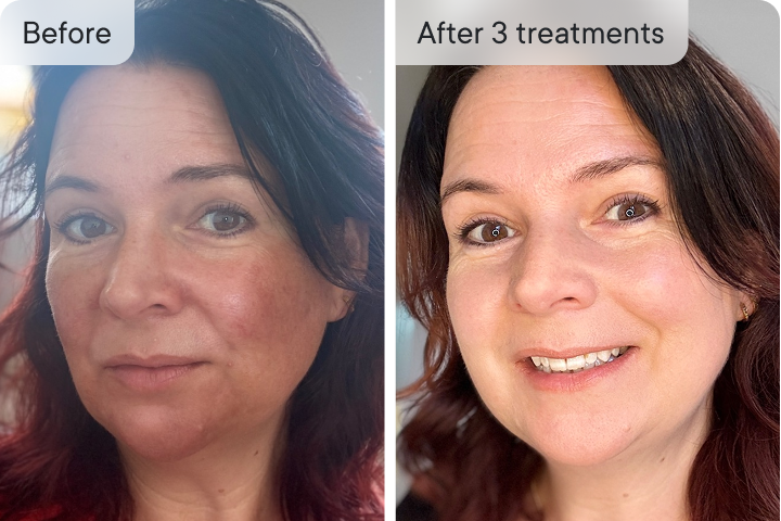HoMEso Customer before and after results