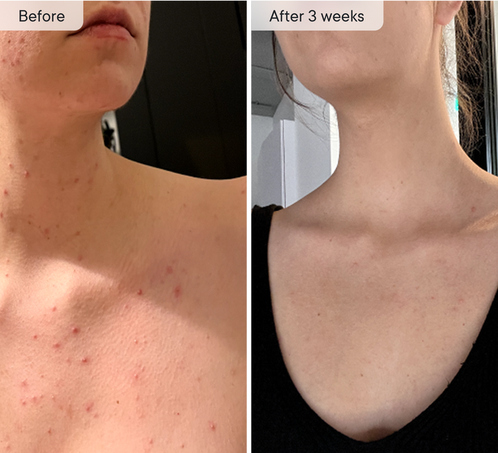 Neck & Décolletage LED Device