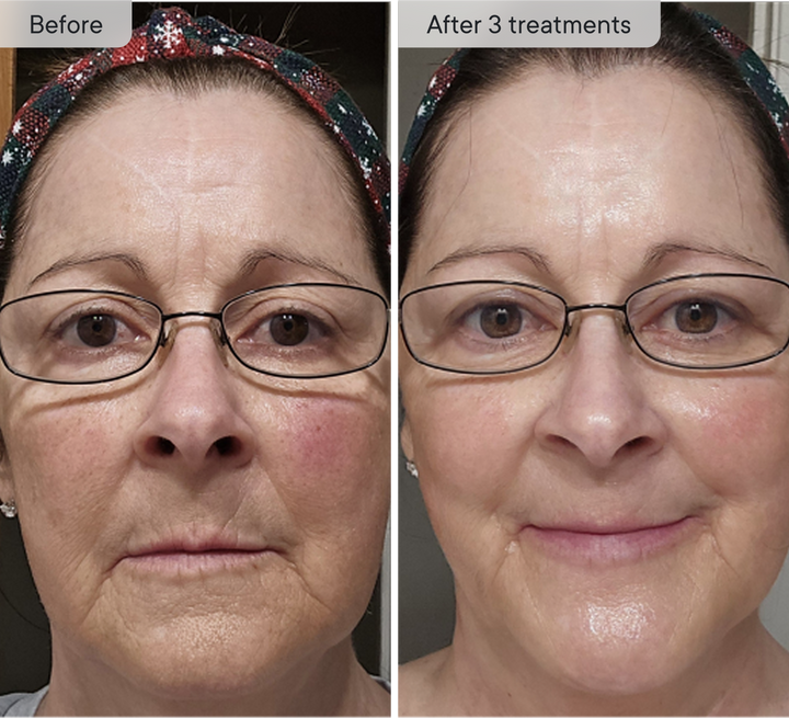 Qure Micro-Infusion System #1 Derm Rated Original Micro-Infusion Qure Micro-Infusion System #1 Derm Rated Original Micro-Infusion
