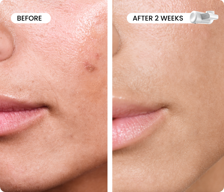 Line Refine Bundle Advanced