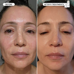 Micro-Infusion 3 Month Bundle (For Wrinkles)