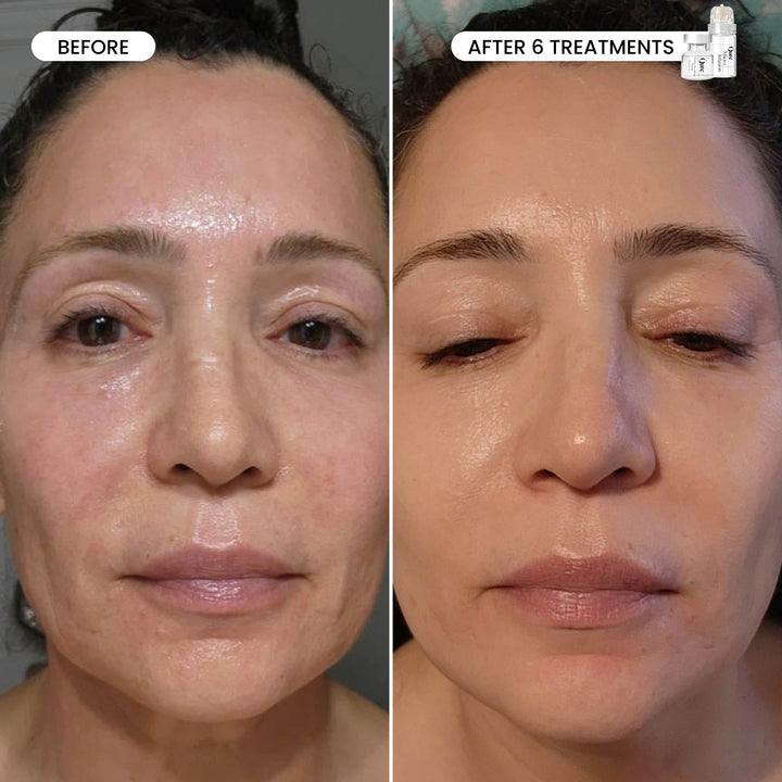 Micro-Infusion 1 Month Bundle (For Wrinkles)