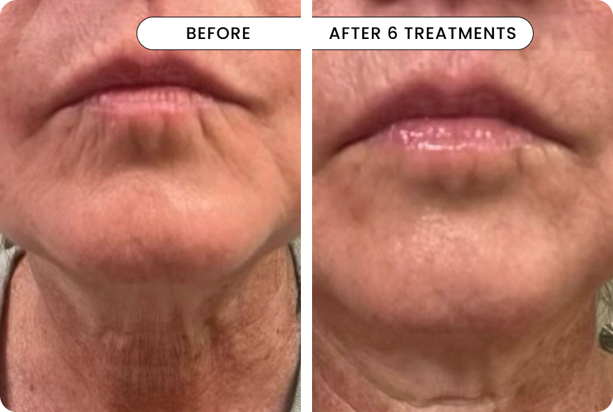 result Micro-Infusion 3 Month Bundle (For Wrinkles)