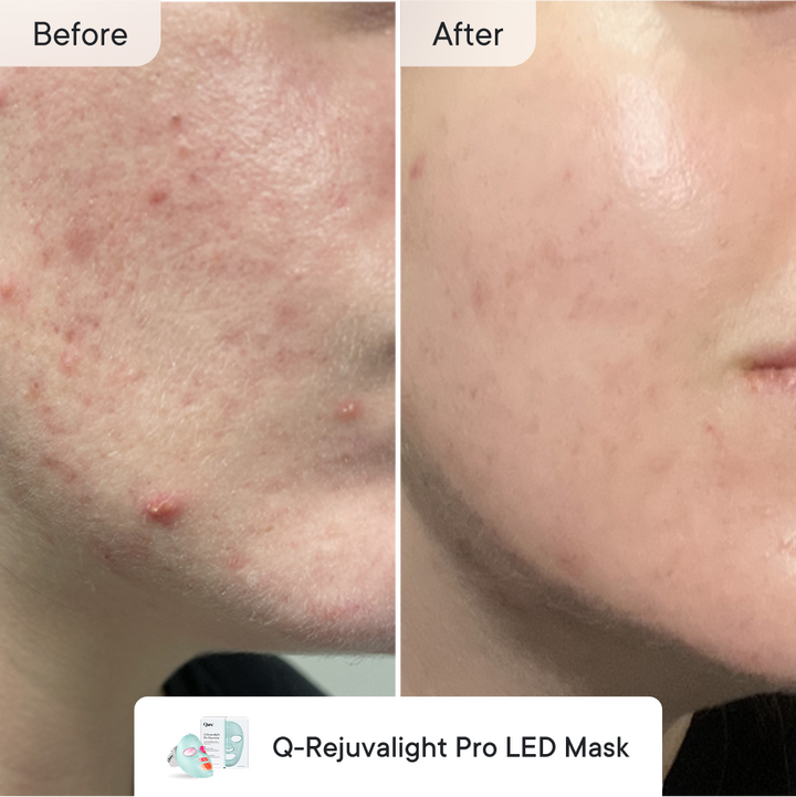 Breakout Control  Advanced